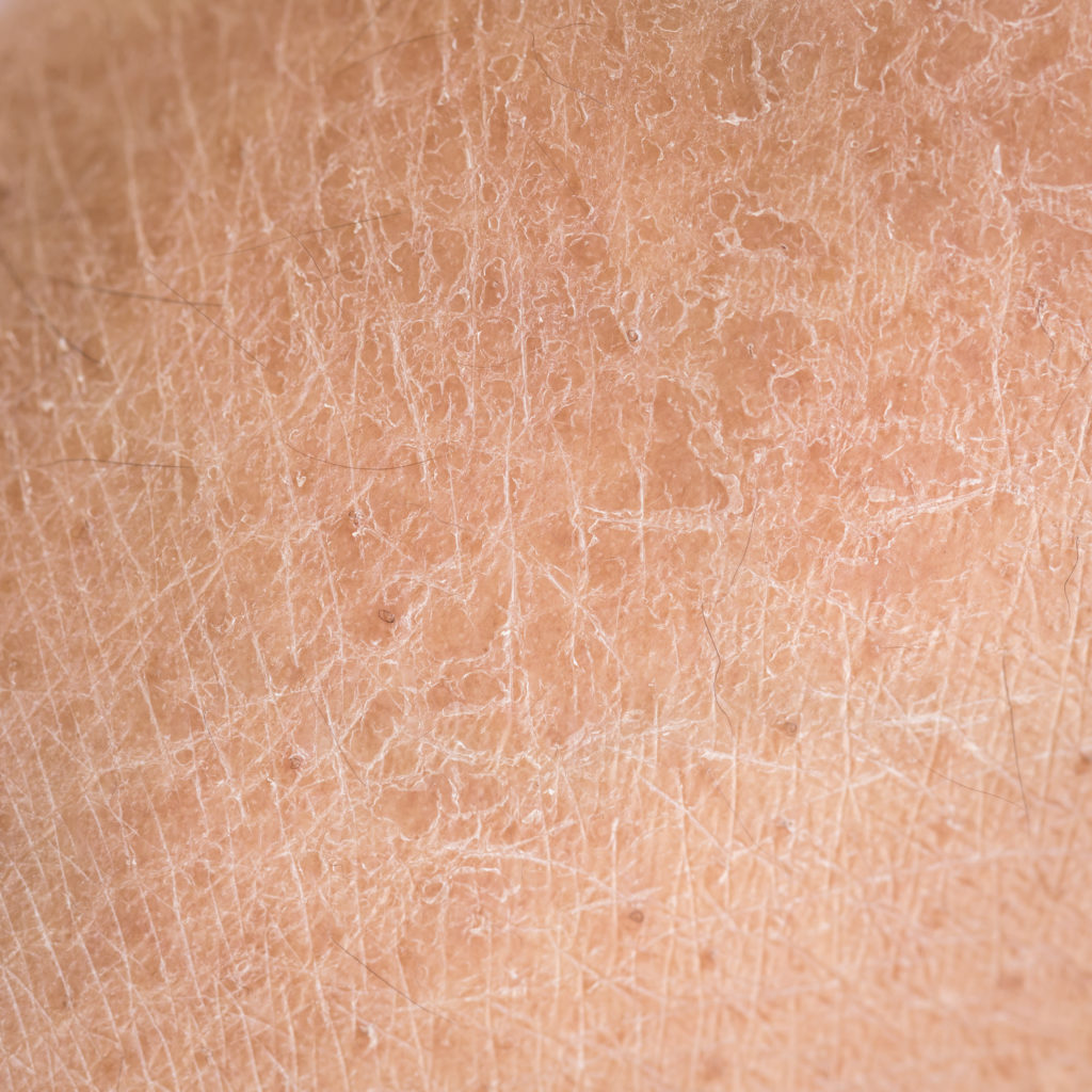 Boren handig Torrent Droge huid behandeling nodig? Medical Beauty Center
